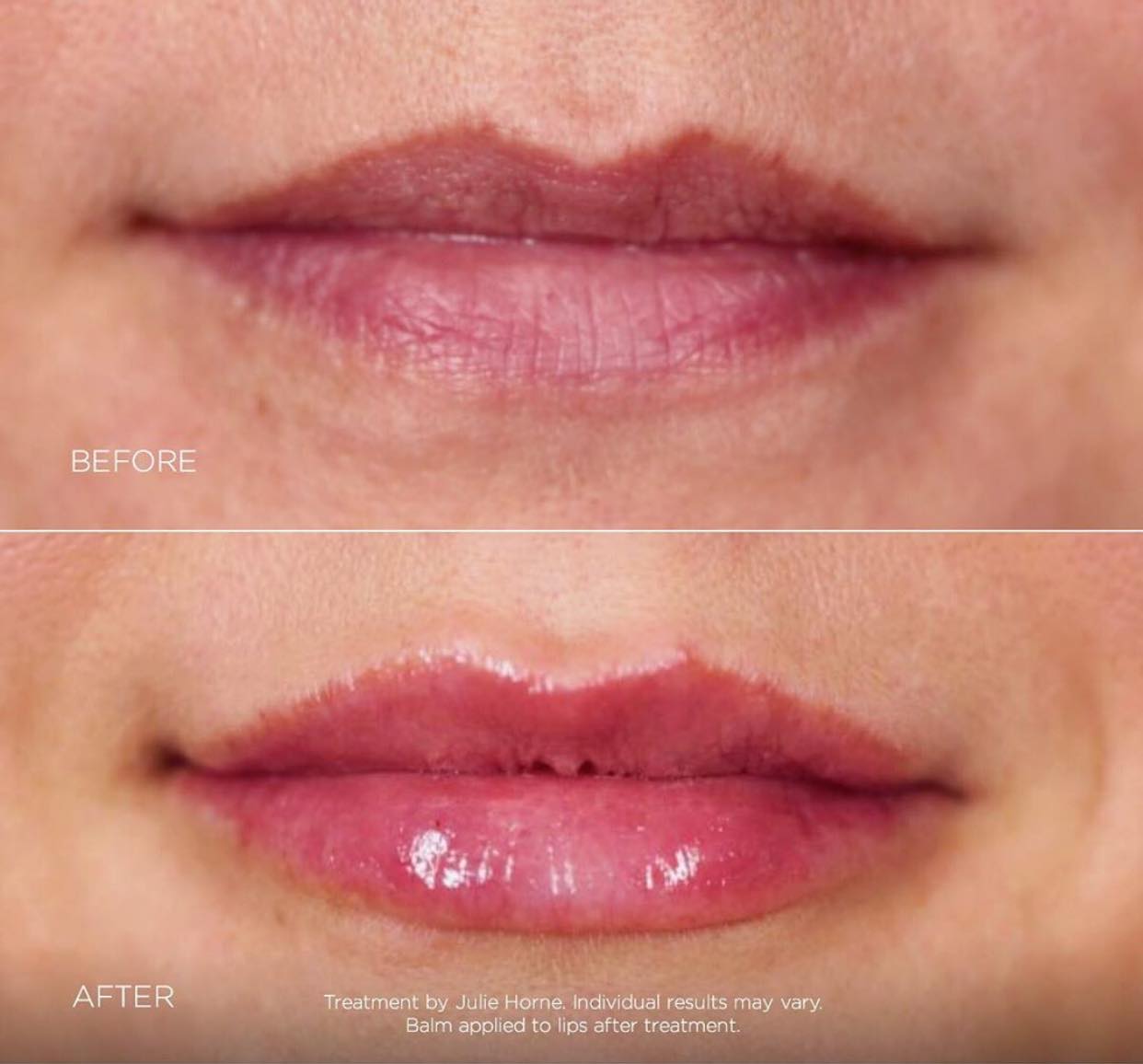 Lip enhancement using dermal fillers